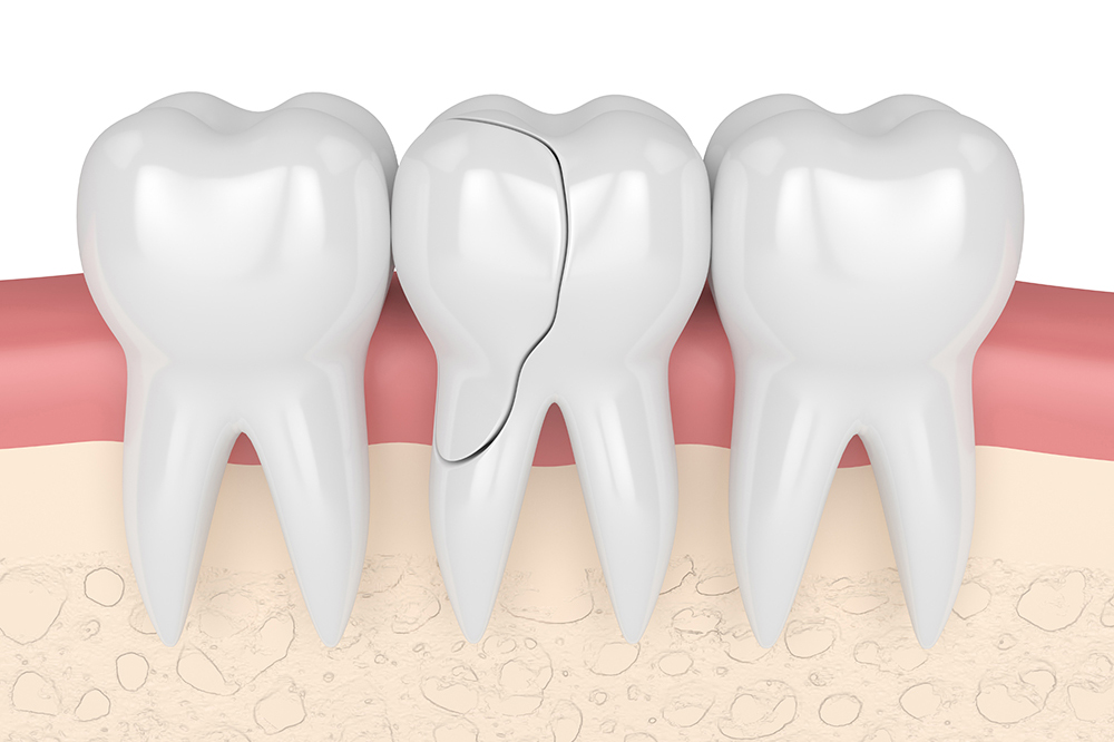 Chipped or missing teeth