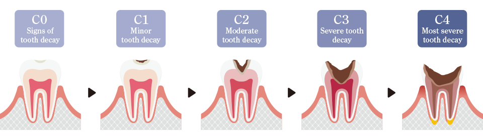 Toothache, sesitive teeth